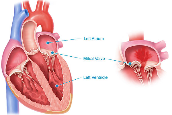 Mitral regurgitation mitral valve 600x400