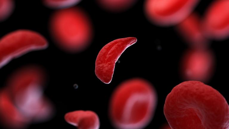 3D rendered image shows a close-up image of a sickle-shaped red blood cell surrounded by mixture of normal blood cells and sickled cells.