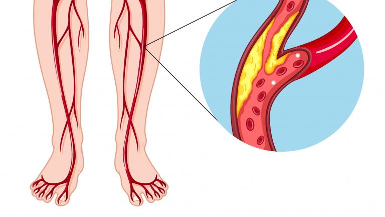 Diagram illustration of Peripheral arterial disease