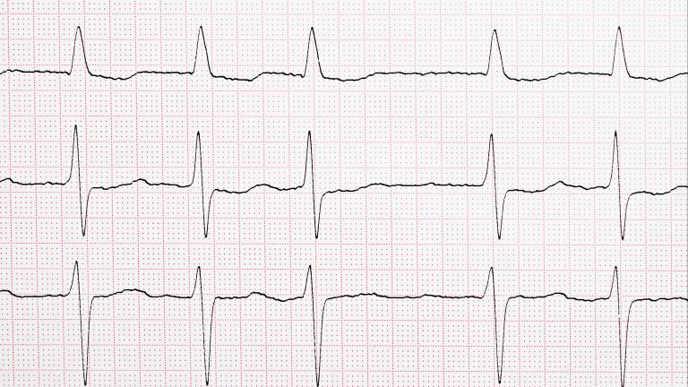 A photo of atrial fibrillation, an irregular heart rhythm. 