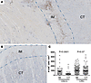 Differences in density and location of immune infiltrate in OSCC, as a typi