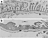 Morphologic alterations seen in PAN-treated kidney. (a) Portion of a glomer