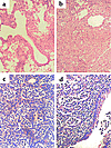 Lung histology in the first week after injection of AdhIL-1β showed acute i