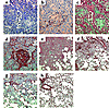 Fibrogenic responses in the lung after intratracheal injection of AdhIL-1β.