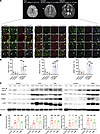 mTOR activation–sensitive genes in patients’ brain tissues with somatic mut