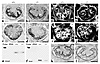 Expression of actin cytoskeleton–associated proteins and GBM components in