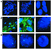 Detection of dystrophin exon 45 deletion in DMD-BMT1 and his mother by FISH