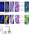 Spatial metabolomics identifies adenine in regions of pathology in nonmacro