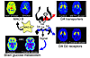 Images obtained with PET (axial sections) that show the effects of chronic