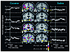 Images of coronal sections obtained with fMRI, showing areas of brain activ