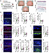 Calcipotriol-plus–5-FU immunotherapy induces robust Th2 immunity in AKs ass