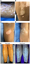 Clinical signs of active vitiligo lesions.