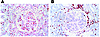 Immunohistochemical staining of a lupus renal biopsy. (A and