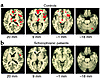 Generic brain-activation maps in response to a PL task. (a) In healthy subj