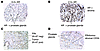 Standard IHC on selected TMA prostate tissue cores illustrates the variabil