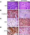 A subset of Six1 tumors show a complete EMT.