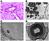 Morphological features of glial and neuronal protein aggregates in Alexande