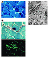 Myopathological images of skeletal muscle in patients with desminopathy.