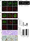 Hyperactivation of mTORC1 induces ER stress and EMT-like phenotype in podoc