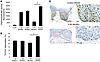 A mutation in PSMB8 reduces proteasomes activity.