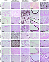 Tumor goblet cells are not dependent on the SPDEF/FOXA3 transcriptional pro