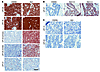 Comparison of Ab3 and CM2B4 immunohistochemistry staining of MCC.