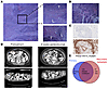 Histologic, radiologic, and genomic characteristics of a patient with POLE-