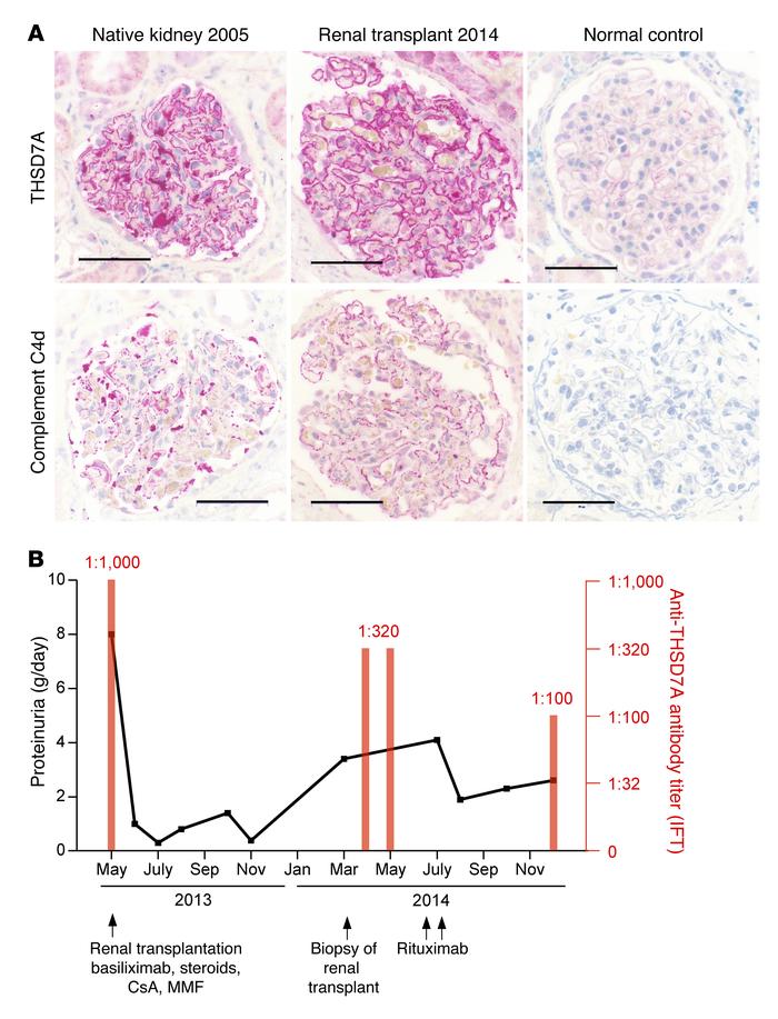 Serum anti-THSD7A antibody positivity and recurrence of MN after renal t...