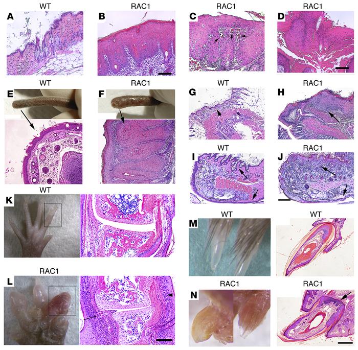 Epidermal RAC1 activation produces a psoriasiform phenotype including sk...