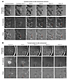 Centripetal lesions: persistent versus transient phase rim during follow-up