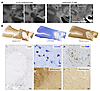 MRI/pathology of demyelinated lesions with persistent phase rim.