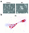 Neutral lipid accumulates in hypertrophied cardiac myocytes. (a) Phase-cont