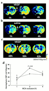 CBF maps of coronal sections measured by perfusion-weighted MRIs. Images of