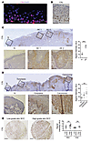 Higher CSL expression in premalignant and malignant squamous cancer lesions