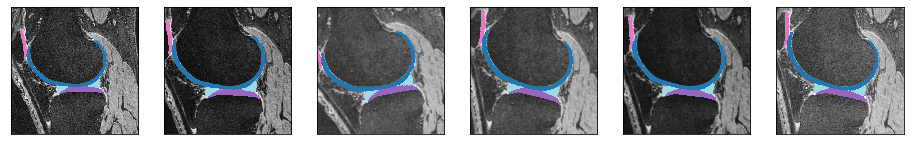 Knee MRI