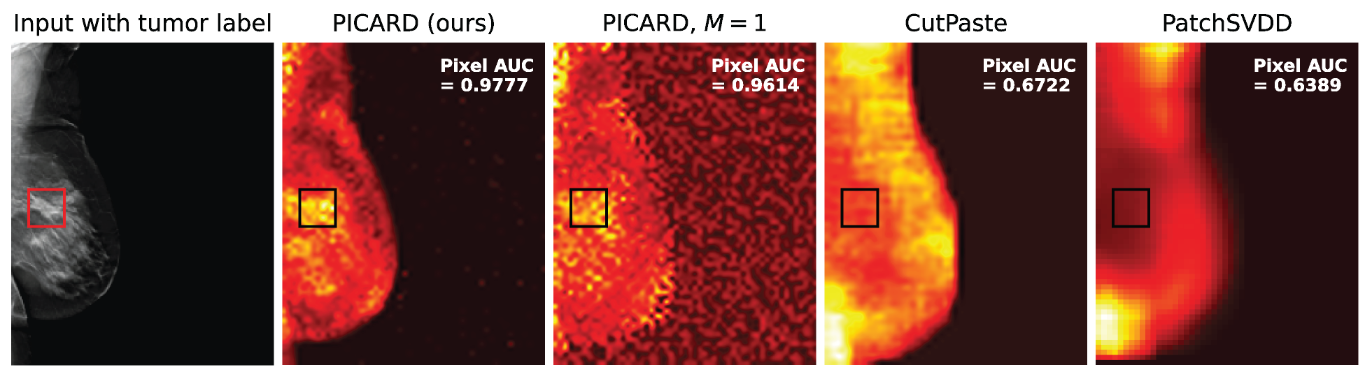 Anomaly heatmaps for a breast tomosynthesis image generated by various methods; ours is furthest to the left.