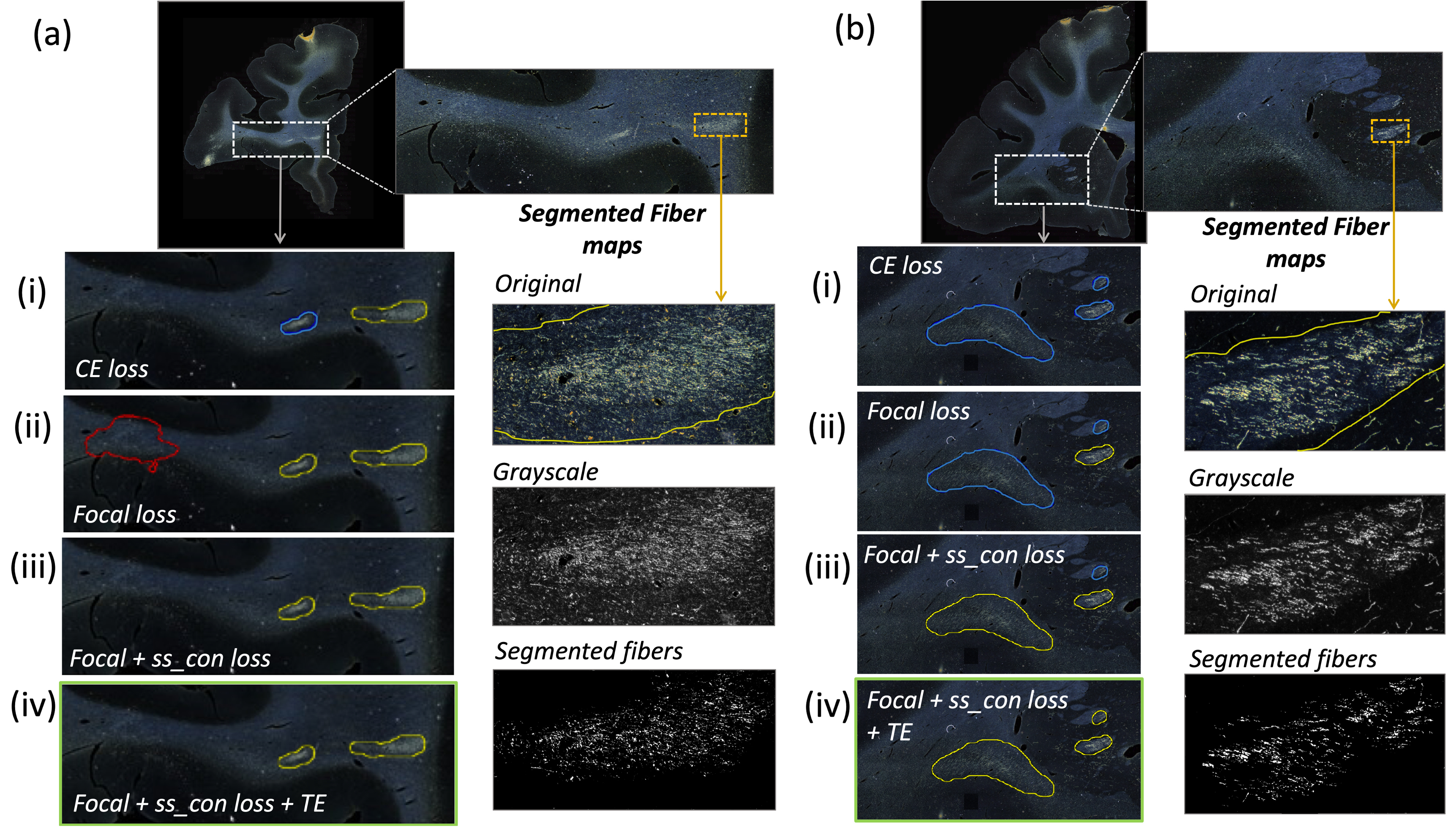 Two sample results of the ablation study, with the profile of fibers within detected bundles.