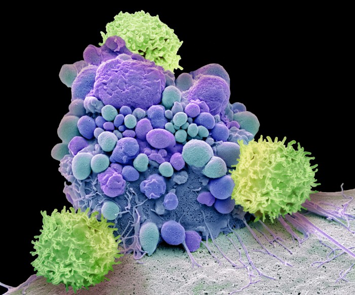 Composite coloured scanning electron micrograph of T-cells and an apoptotic brain cancer cell shown in green and purple colours