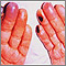 Cryoglobulinemia of the fingers