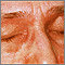 Dermatomyositis - heliotrope eyelids