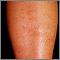 Polyarteritis - microscopic on the shin