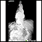 Radiografía de una hernia hiatal