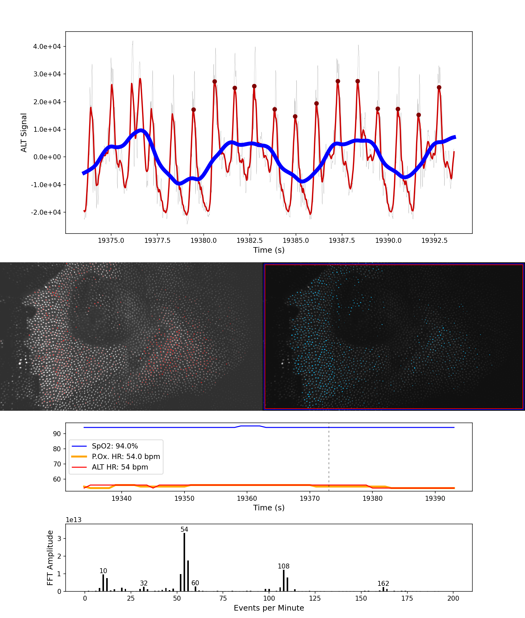 An example of using the ALT tech to monitor respiration during sleep