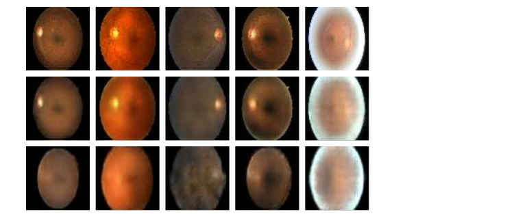 diabetic-retinopathy-results