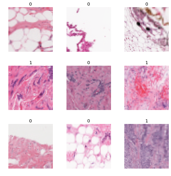 Breast-Cancer-Detection-using-Deep-Learning