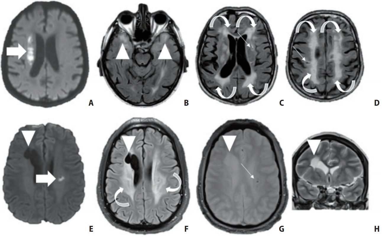 Brain_Hemorrhage_Classifier_OctConvResnet