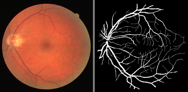 Retina_Blood_Vessel_Segmentation