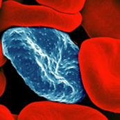 Colorized scanning electron micrograph of red blood cell infected with malaria parasites (blue). The small bumps on the infected cell show how the parasite remodels its host cell by forming protrusions called 'knobs' on the surface, enabling it to avoid destruction and cause inflammation. Uninfected cells (red) have smoother surfaces. Credit: NIAID