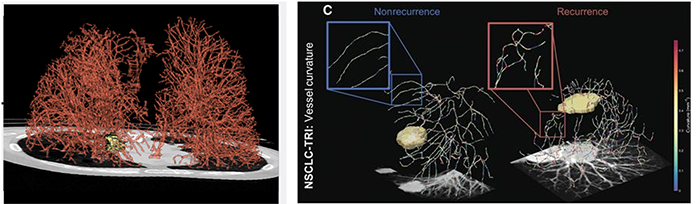 At left is a 3-dimensional reconstruction of lung blood vessels in a cancer patient generated from CT scans. Researchers examined the shape and size of the blood vessels, as well as how often they twisted and turned as they reached the tumor. At right, blood vessels surrounding the tumor are shown from two lung cancer patients, one of whom did not have the cancer return after treatment (left) and one who did (right). Researchers found that patients who did not have the cancer return had fewer twisted blood vessels.