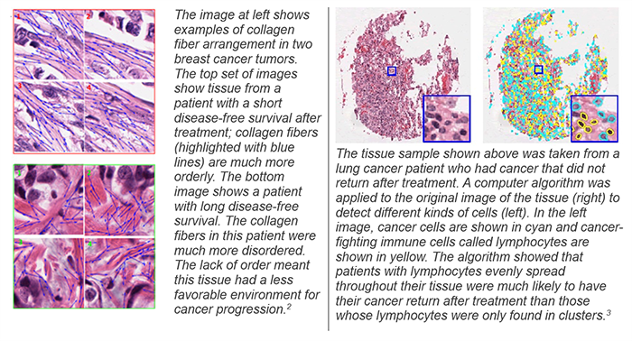 Left image: The image at left shows examples of collagen fiber arrangement in two breast cancer tumors. The top set of images show tissue from a patient with a short disease-free survival after treatment; collagen fibers (highlighted with blue lines) are much more orderly. The bottom image shows a patient with long disease-free survival. The collagen fibers in this patient were much more disordered. The lack of order meant this tissue had a less favorable environment for cancer progression. Top image: The tissue sample shown above was taken from a lung cancer patient who had cancer that did not return after treatment. A computer algorithm was applied to the original image of the tissue (right) to detect different kinds of cells (left). In the left image, cancer cells are shown in cyan and cancer-fighting immune cells called lymphocytes are shown in yellow. The algorithm showed that patients with lymphocytes evenly spread throughout their tissue were much likely to have their cancer return after treatment than those whose lymphocytes were only found in clusters.